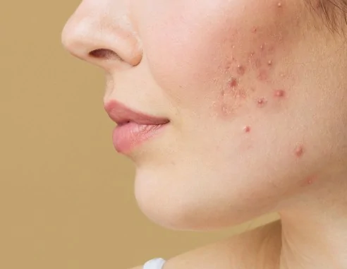 Imagen del producto Tratamiento Potenza para el acné | e-Quirónsalud