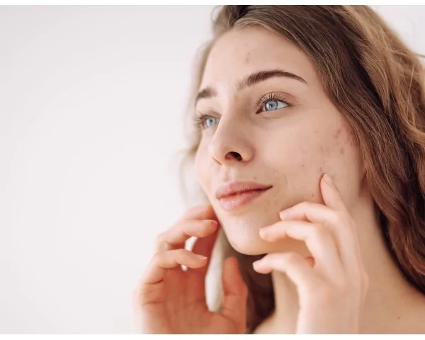 Imagen del producto Láser CO2 fraccionado para cicatrices y marcas de acné