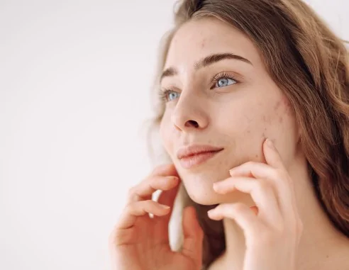 Imagen del producto Láser CO2 fraccionado para el acné | e-Quirónsalud