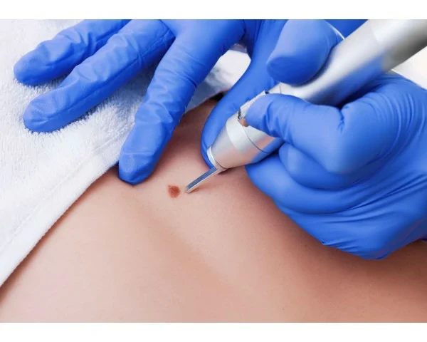 Imagen del producto Consulta de dermatología con electrocoagulación